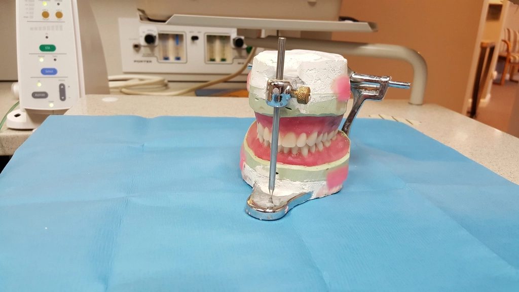 Sau — Trồng răng implant một răng hàm — ảnh mô hình minh hoạ