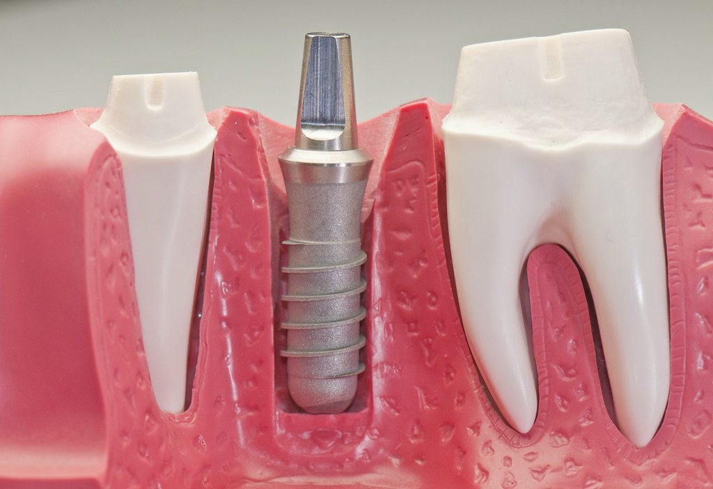 Trước — Trồng răng implant một răng hàm — ảnh mô hình minh hoạ