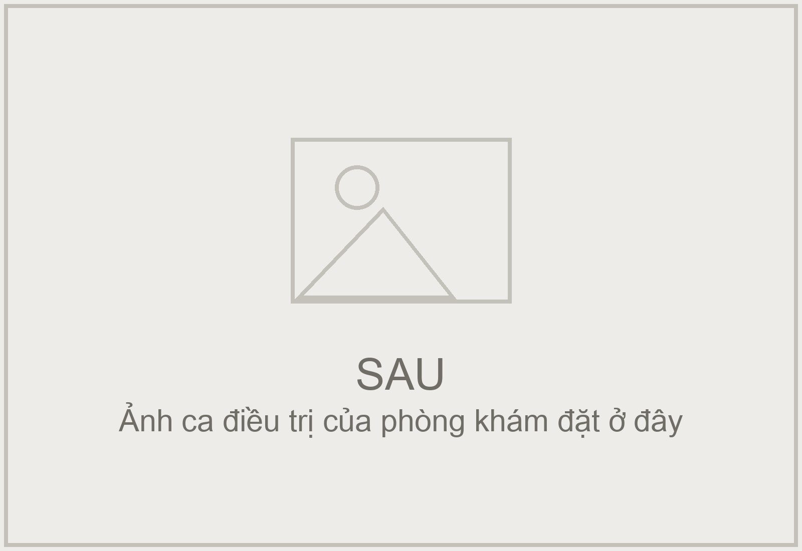 Sau — Trám hai răng cửa sâu mặt ngoài